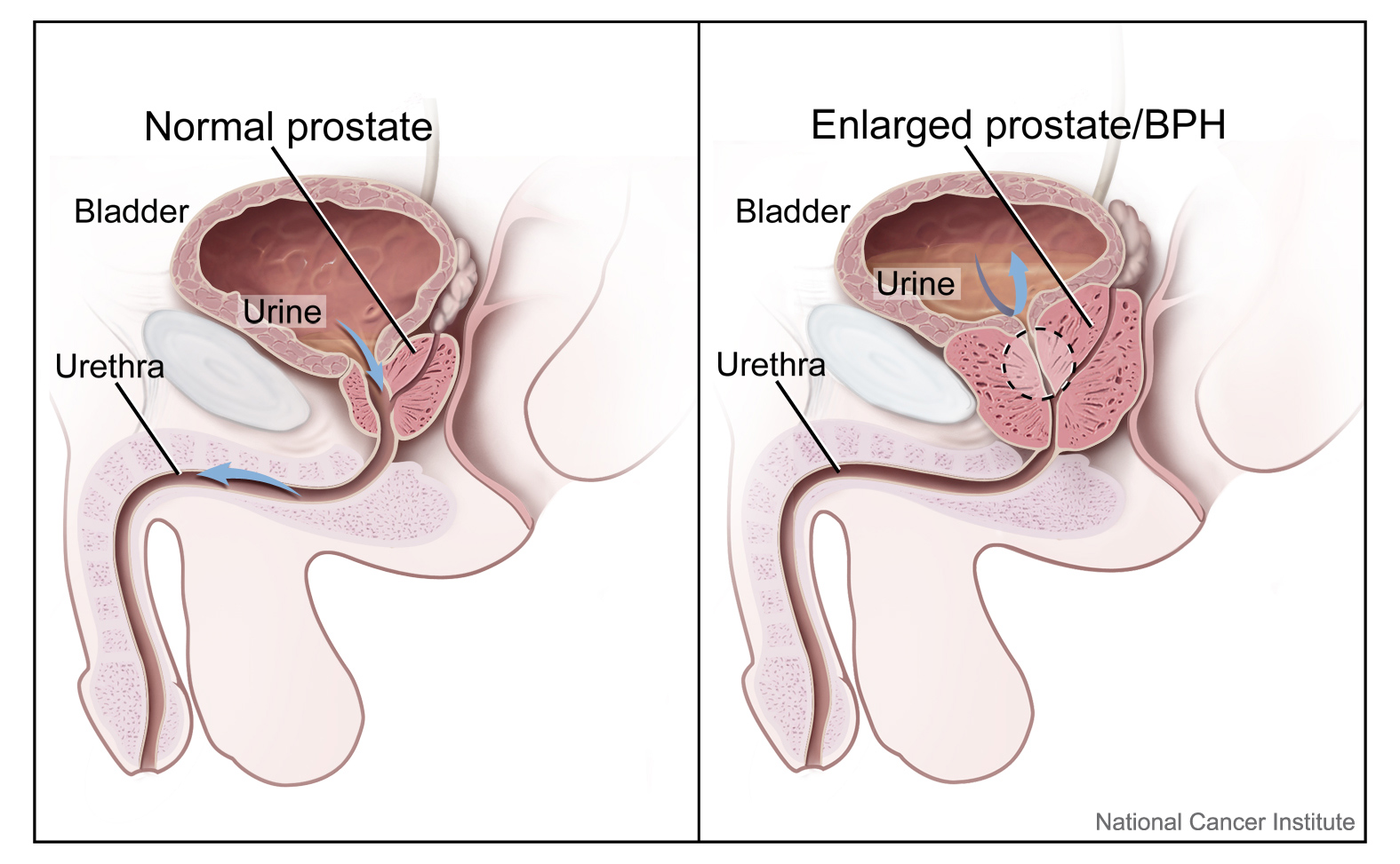 leczenie przerostu prostaty