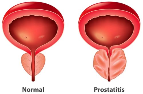 przerost prostaty